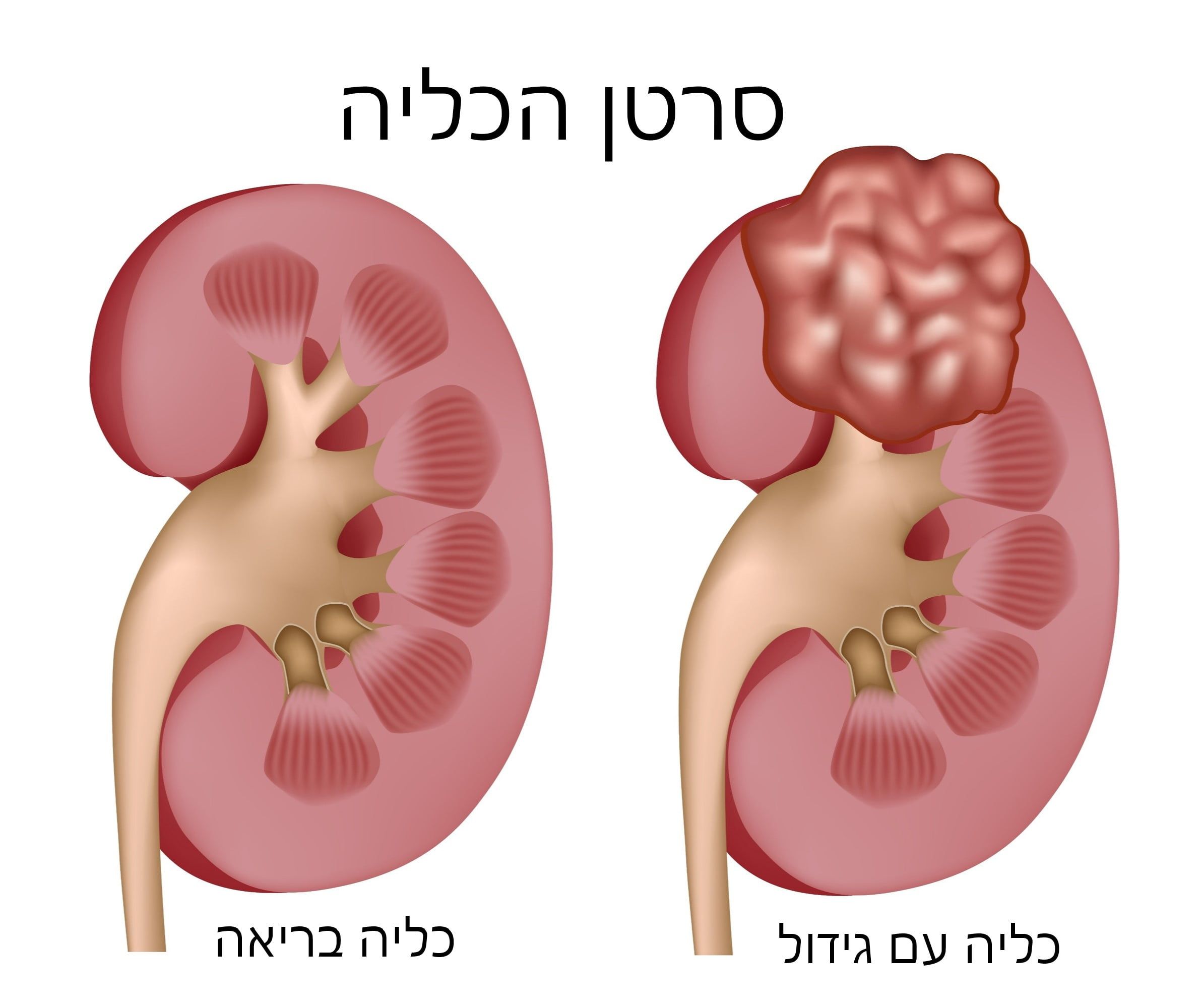 סרטן כליות - כיצד זה נראה?